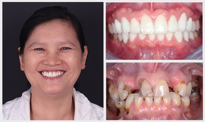 Làm răng sứ thẩm mỹ lưu giữ vẻ đẹp trong bao lâu?