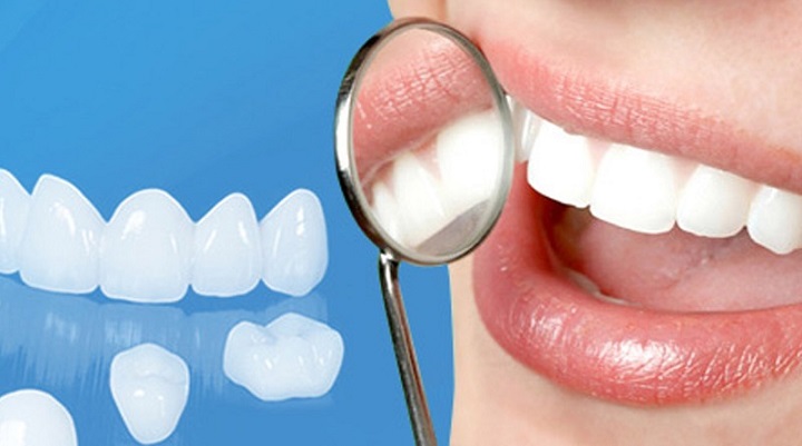 Ưu điểm của phương pháp bọc răng sứ Cromcoban