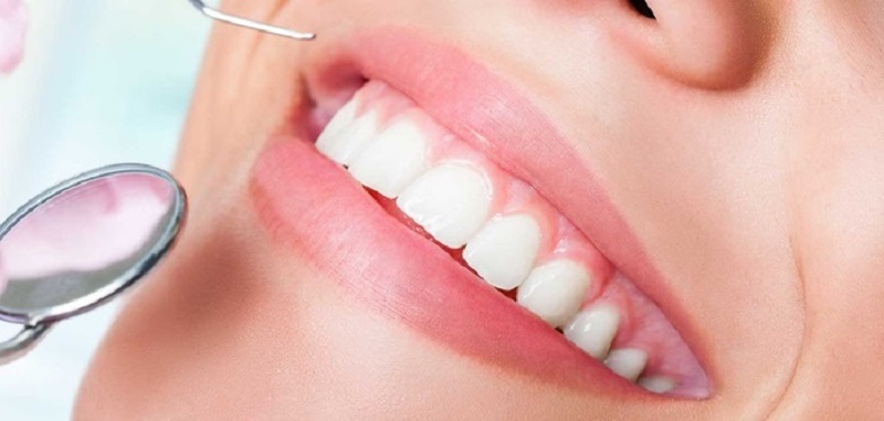 Tuổi thọ của phương pháp bọc răng sứ là bao lâu?
